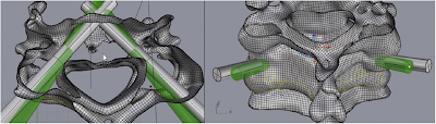 3D Printed Surgical Guides Combined with Monitored Guidewires for Placement of Cervicothoracic Pedicle Screws